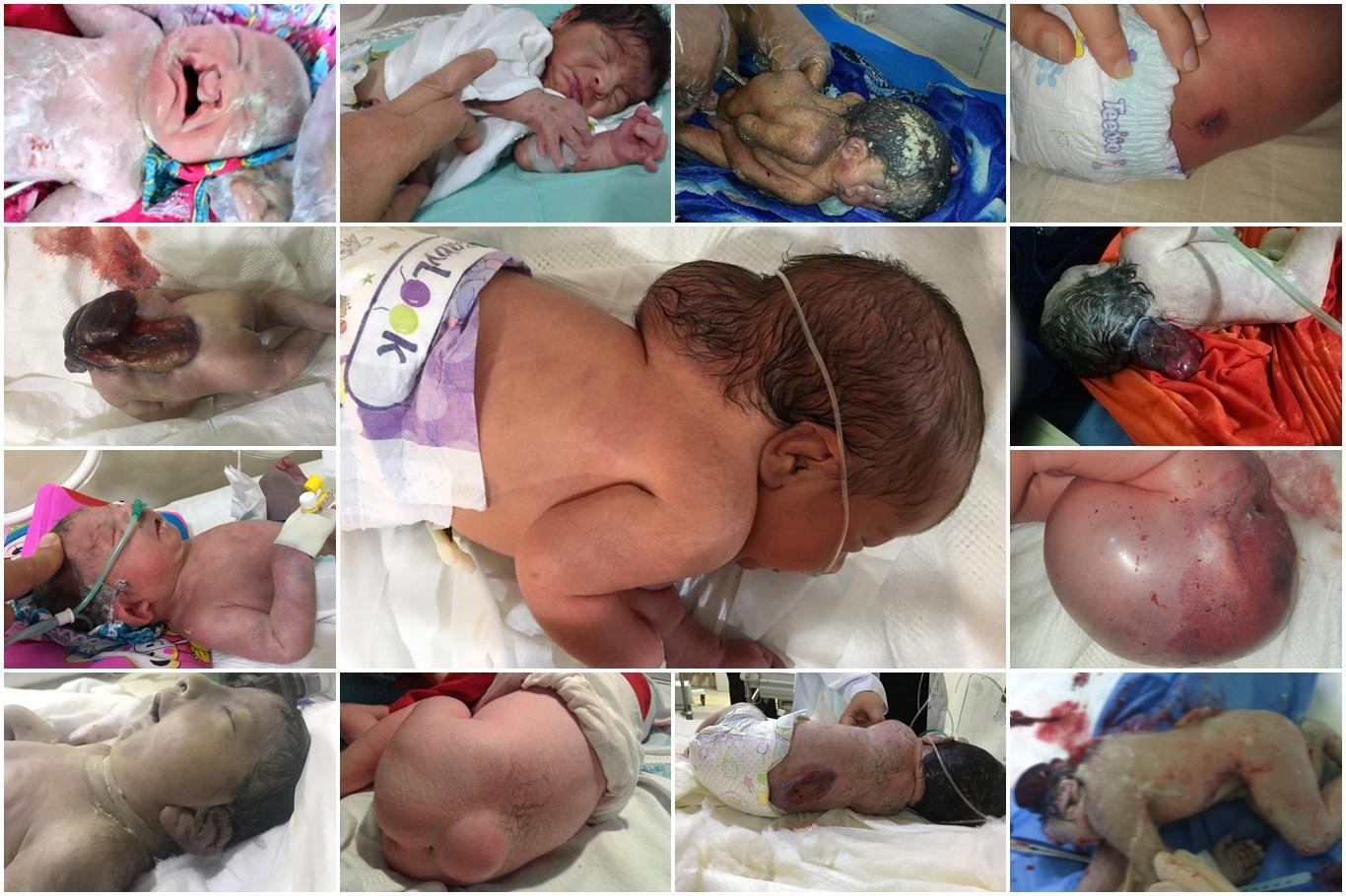 Babies born disabled because of chemical weapons used by The U.S.